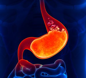 Fast Tract Diet Q&A - Acid Reflux: Fats or Carbs? 