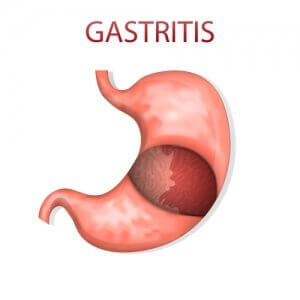 Fast Tract Diet Q&A - Is the Fast Tract Diet Effective for Gastritis?